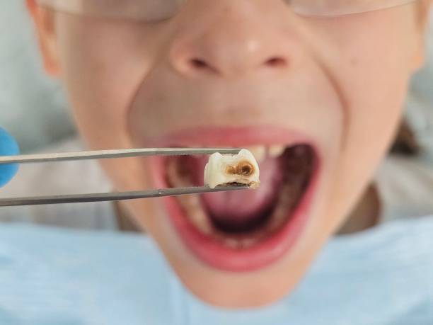 Best Emergency Dental Care for Broken or Chipped Teeth in South Monroe, MI