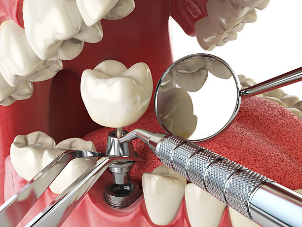 Best Emergency Treatment for Dental Infections or Abscesses in South Monroe, MI